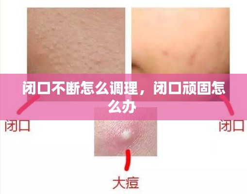 闭口不断怎么调理，闭口顽固怎么办 