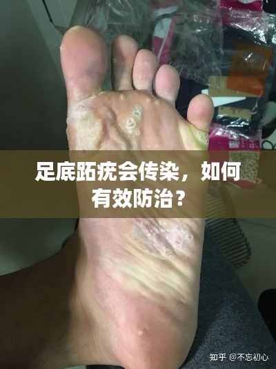 足底跖疣会传染,如何有效防治?